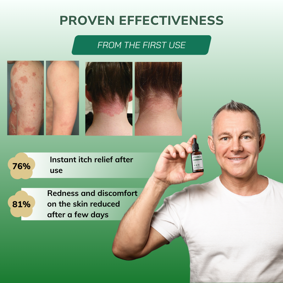 Atoskin Skin Recovery Cream 30g - Krim Eczema, Psoriasis, ekzema, Tidak Mengandungi Corticoid
