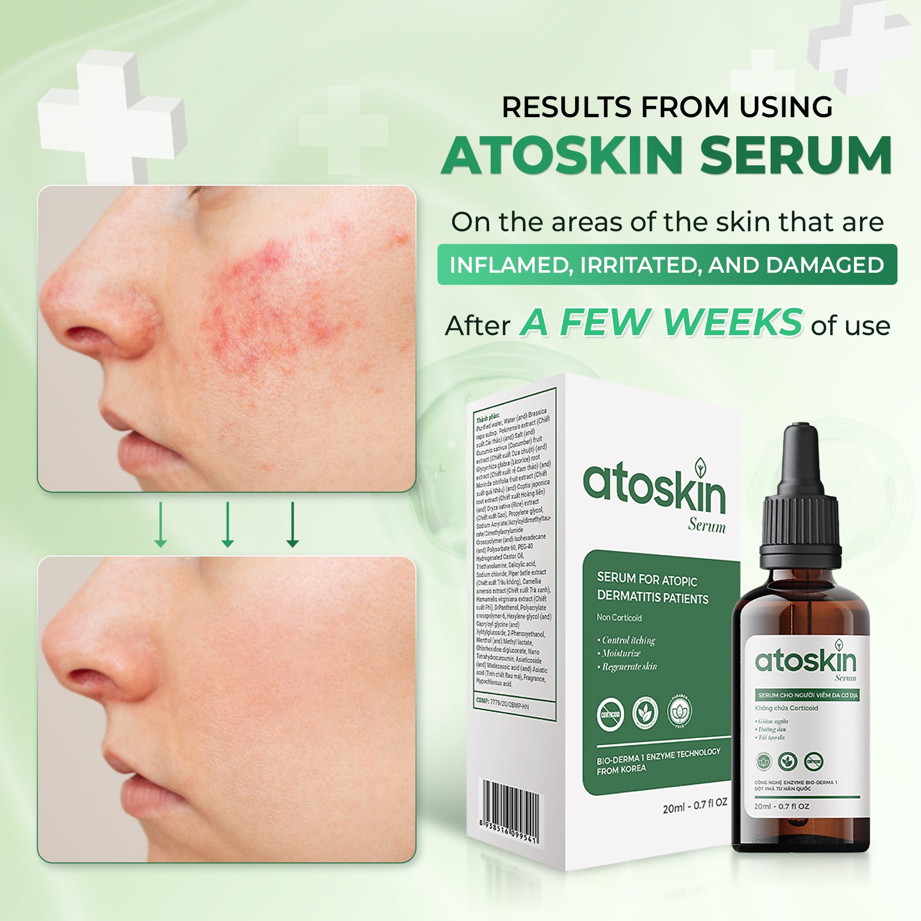 ATOSKIN Serum - Kurangkan kegatalan, psoriasis & ekzema – 7 Hari Nampak Perubahan
