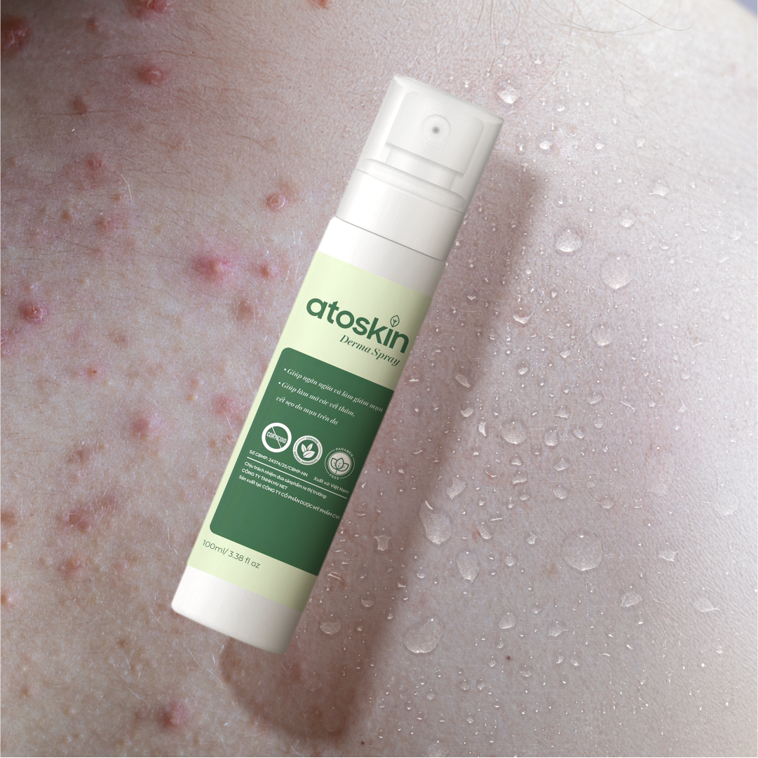 Semburan Jerawat Belakang ATOSKIN 100ml – Bersih, Kurang Jerawat & Pulih Kulit